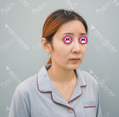 我找張紅芳做面部脂肪填充前 我找張紅芳做面部脂肪填充前