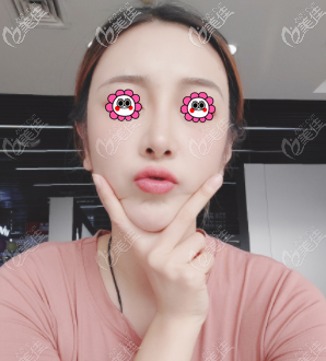 說張紅芳脂肪填充技術好是因為創(chuàng)傷小塑形也比較自然呢 說張紅芳脂肪填充技術好是因為創(chuàng)傷小塑形也比較自然呢