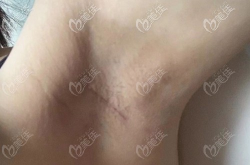 鄭在皓院長(zhǎng)做的手術(shù)切口