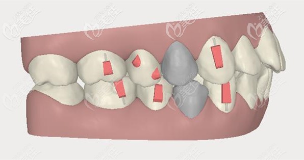 灰色部位是需要拔掉的牙齒 灰色部位是需要拔掉的牙齒