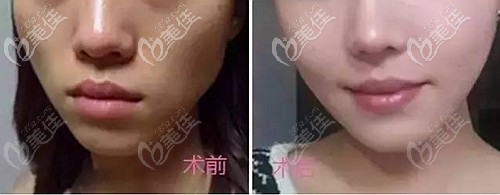 都在說南陽維多利亞做面部脂肪填充有什么樣的好處，但我想問有弊端沒