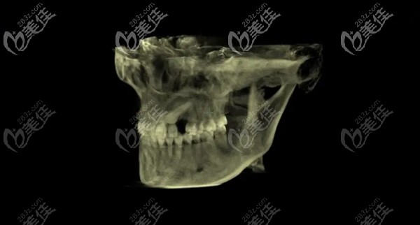 牙齒全景片 牙齒全景片