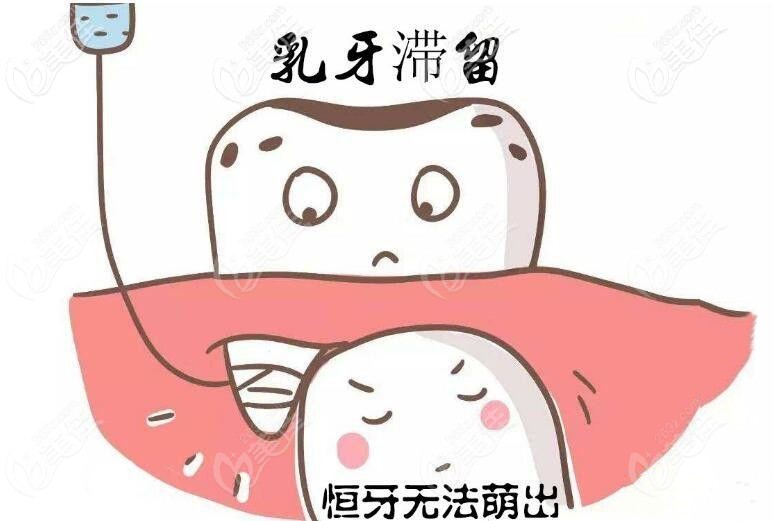 成人乳牙滯留 成人乳牙滯留