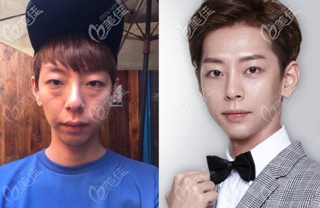 眶隔釋放效果圖