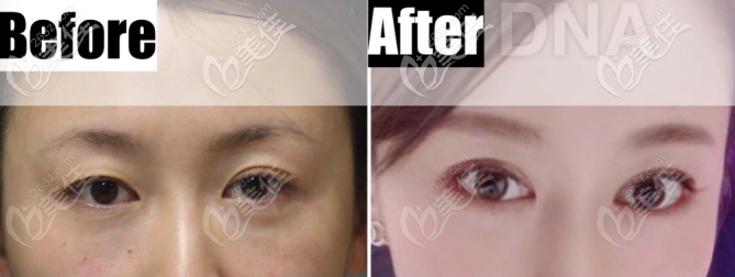 雙眼皮不對(duì)稱矯正