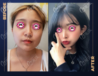 韓國DA隆鼻怎么樣？南東佑院長做的自體耳軟骨隆鼻<span style=