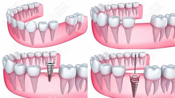 種植牙的流程圖