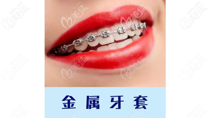 想要了解新鄉(xiāng)金屬牙套價格的看這里