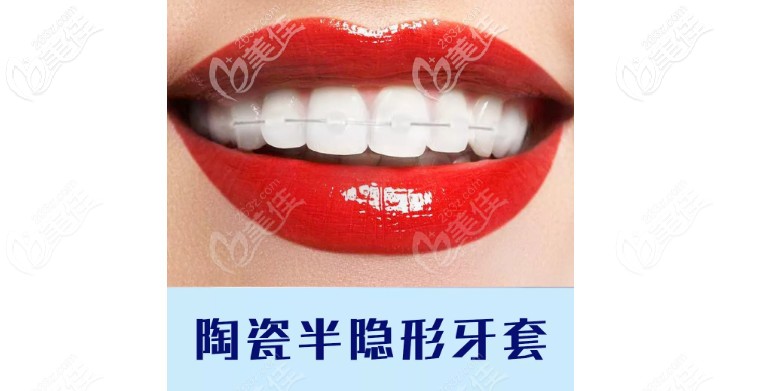 陶瓷半隱形托槽矯正價格在這里了