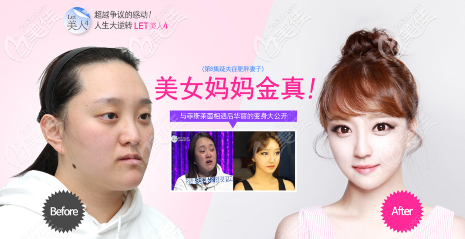 韓國(guó)雙鄂手術(shù)好的醫(yī)院-韓國(guó)菲斯萊茵整形醫(yī)院