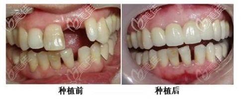 種植牙前后對比照