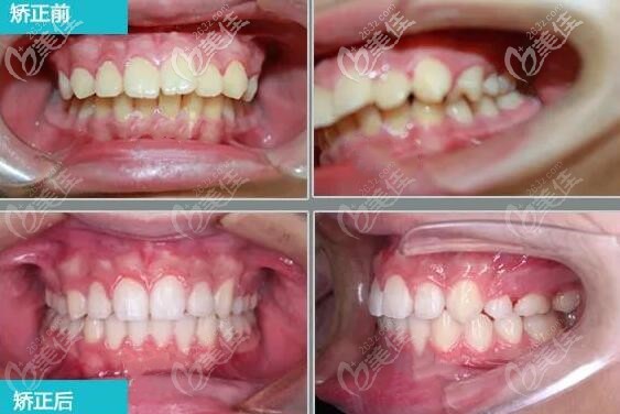 上頜前突下頜后縮牙齒矯正前后圖片