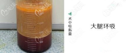 大腿環(huán)吸抽出的脂肪