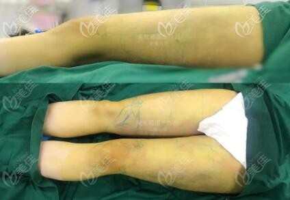 大腿環(huán)吸術(shù)后即刻效果照