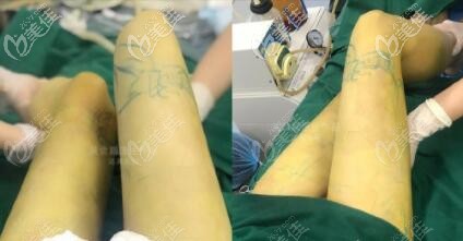 大連達美元辰整形關(guān)世超吸脂案例：做完大腿環(huán)吸后腿細了很多，效果很明顯！