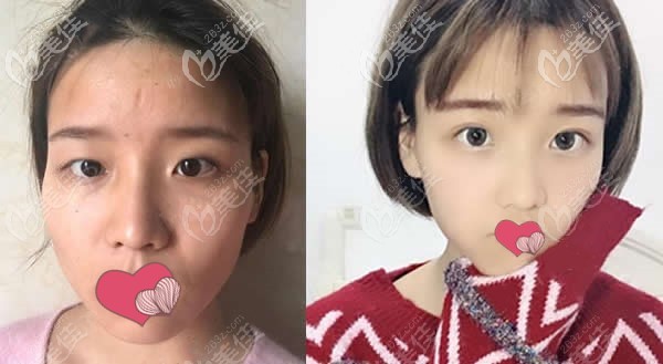 楊琉舒醫(yī)生眼綜合術(shù)前和半年后的效果圖對比