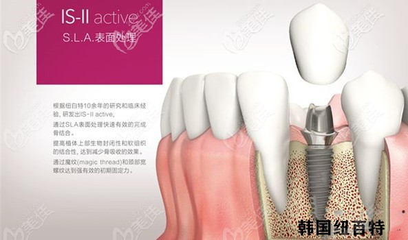 紐百特種植牙特點