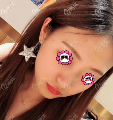 達美如藝郭偉抽脂好嗎？我做面部吸脂10多天效果參考