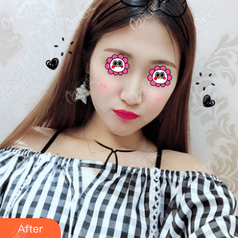 北京郭偉醫(yī)生做面部吸脂還挺好,我做完到現(xiàn)在皮膚沒松弛還挺緊致的