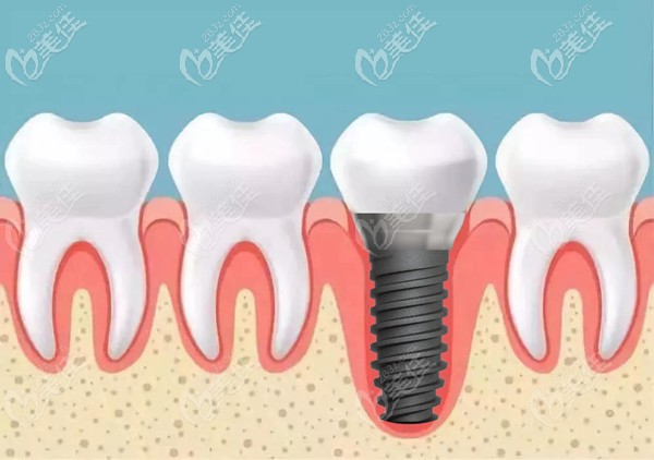 埃克斯種植體的美學即刻種植系統(tǒng)
