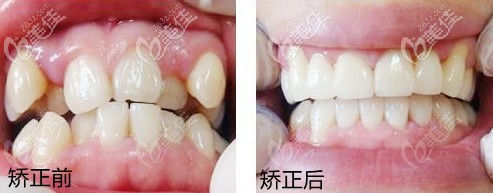 陳勇醫(yī)生的矯正案例