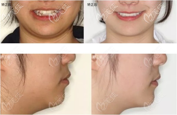 矯正前后的面部變化圖 矯正前后的面部變化圖
