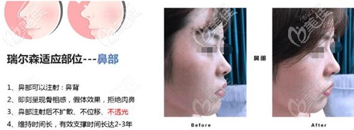 瑞爾森液態(tài)骨雕隆鼻的優(yōu)勢