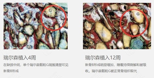 注射瑞爾森液態(tài)骨雕隆鼻后的變化