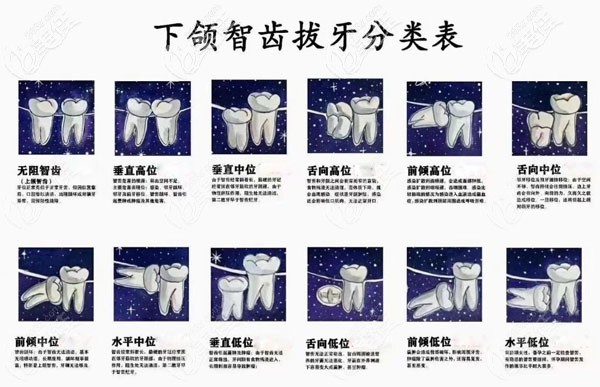 下頜智齒分類表