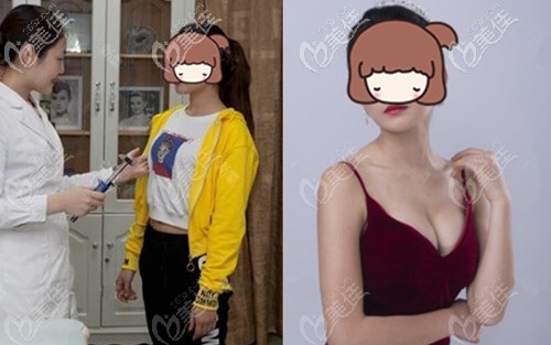 五洲萊美曼托假體隆胸術(shù)后3個(gè)月對(duì)比