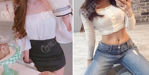 武漢中翰伊思雅假體隆胸案例對(duì)比