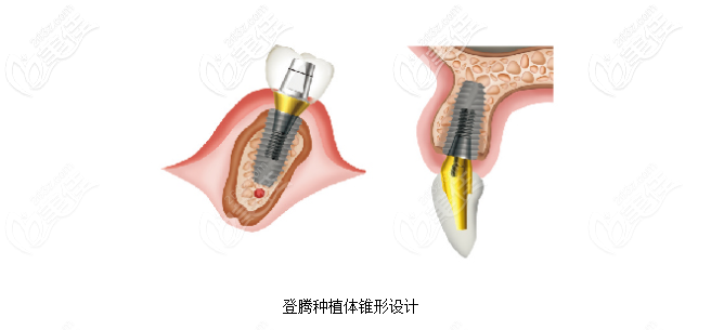 北京圣貝萬柳口腔韓國登騰植體 北京圣貝萬柳口腔韓國登騰植體