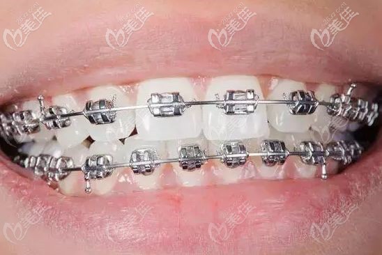 傳統(tǒng)金屬固定矯正器 傳統(tǒng)金屬固定矯正器