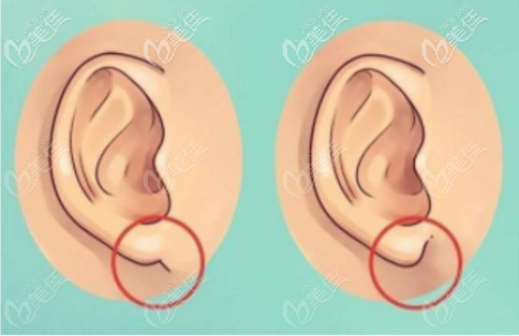 耳垂再造的價(jià)格是多少