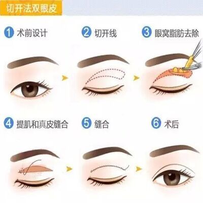 【全切雙眼皮】韓式全切雙眼皮，讓你擁有完美電眼