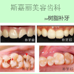 北京斯嘉麗醫(yī)療美容3m樹脂補牙