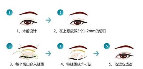 韓式割雙眼皮圖解 小白親看過來~