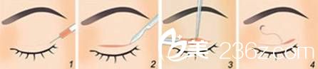 韓式割雙眼皮圖解 小白親看過來~