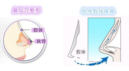 鼻整形醫(yī)生<!--<i data=20240703-sp></i>-->：美鼻不等于隆鼻