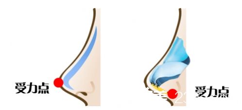 鼻整形醫(yī)生<!--<i data=20240703-sp></i>-->：美鼻不等于隆鼻
