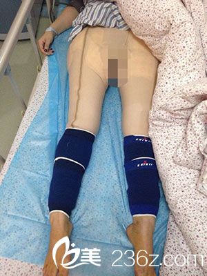 腿部吸脂術(shù)|大象腿怎么辦？