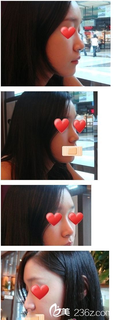 鼻部整形|硅膠隆鼻