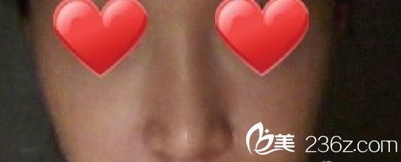 鼻部整形|硅膠隆鼻