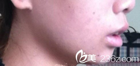 自體脂肪墊下巴|我的尖下巴整形