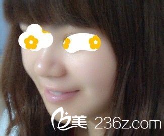 自體脂肪墊下巴|我的尖下巴整形