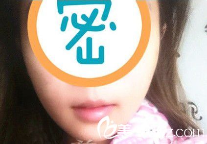 自體脂肪墊下巴|我的尖下巴整形