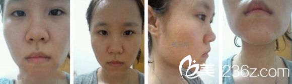 V-line瓜子臉手術(shù)之前