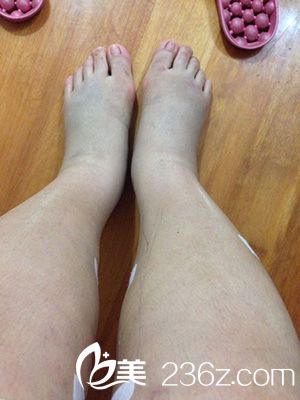 激光溶脂瘦大腿