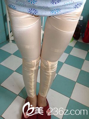 激光溶脂瘦大腿