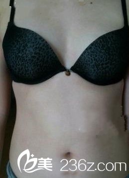 假體隆胸之前